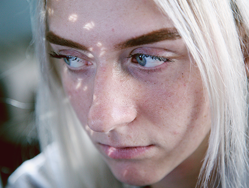 Acne poderá ter vacina 