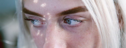 Acne poderá ter vacina 