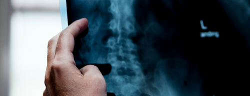 Novo método de radioterapia para câncer de próstata