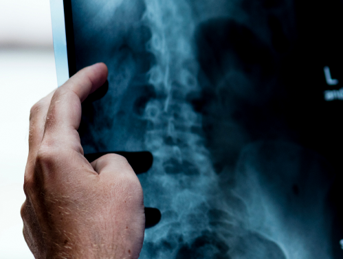 Novo método de radioterapia para câncer de próstata