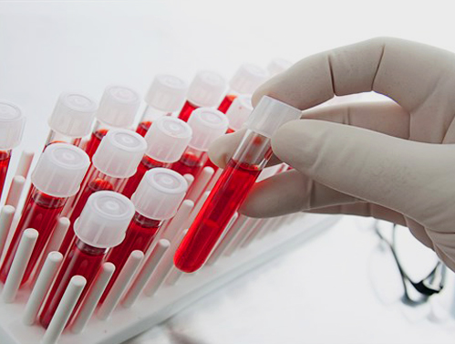 Exame de sangue e câncer pulmonar