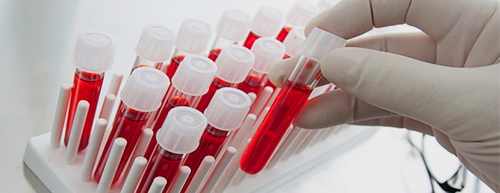 Exame de sangue e câncer pulmonar