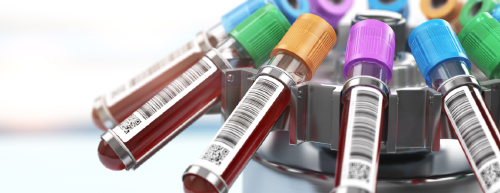 Novo exame de sangue para detectar câncer de próstata