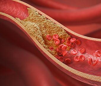 A gordura no risco de AVC