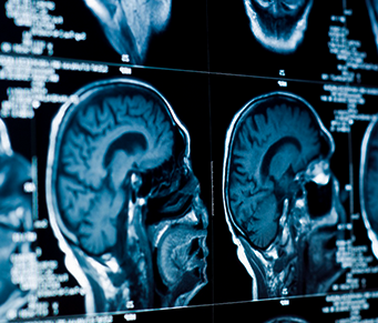 Depressão pode ser “visualizada” no cérebro 