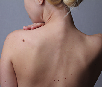 Verrugas olhe com atenção